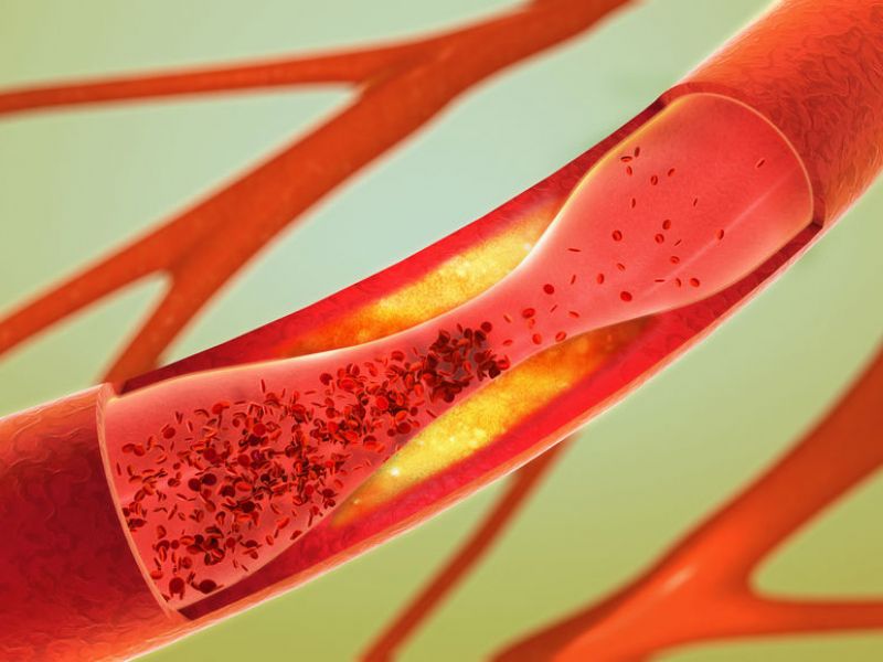 Arteriosklerose - die krankhafte Einlagerung ungesunden Fetten in den Blutgefäßen